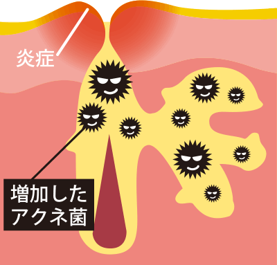 여드름이 악화되어 염증을 일으켜 붉은 여드름에