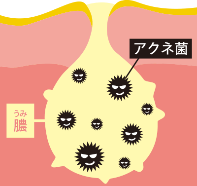 对于黄色痤疮，这是由于脓液堆积而导致的最严重的情况。