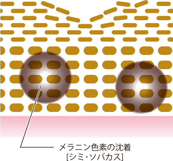 メラニン色素の沈着