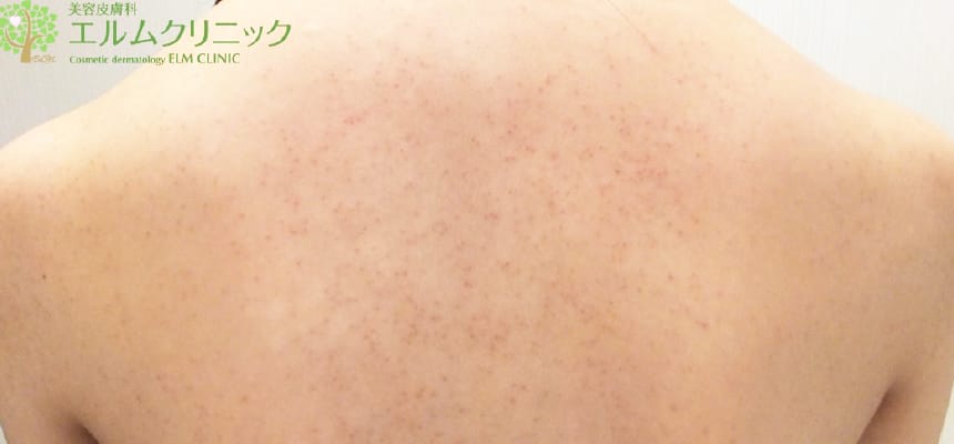 毛孔性角化症が治るまでどれくらいかかりますか?