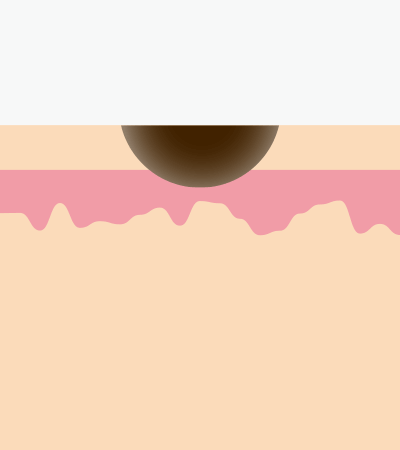 flat, pale mole