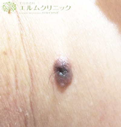 Melanocytic nevus