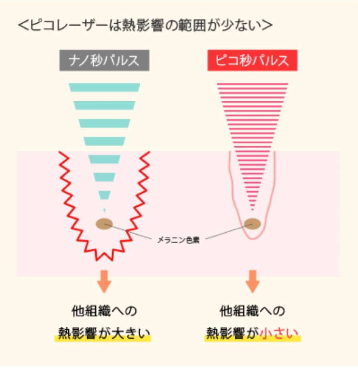 ピコレーザーは熱影響の範囲が少ない