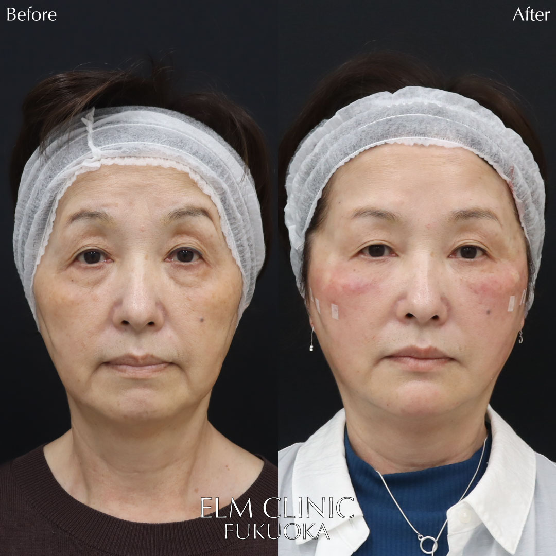 エルムリフトの症例写真