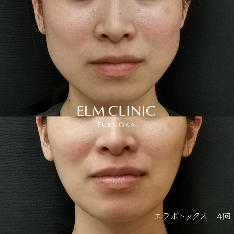 エラボトックス4回の症例写真
