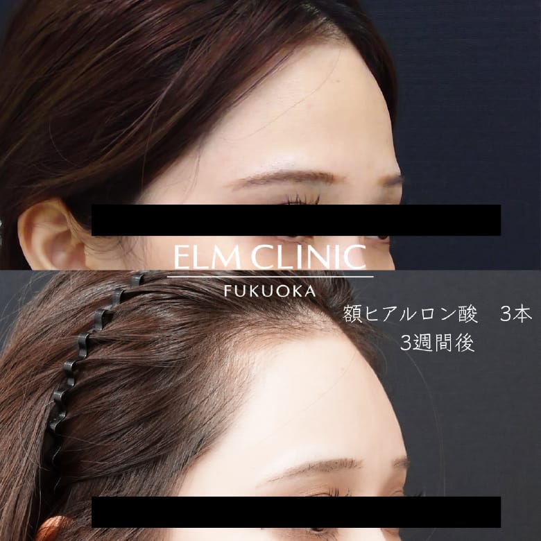 額・こめかみヒアルロン酸注入の症例写真