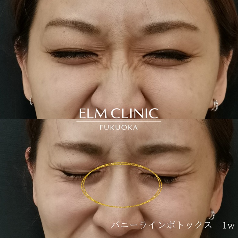 バニーラインボトックス1週間後の症例写真