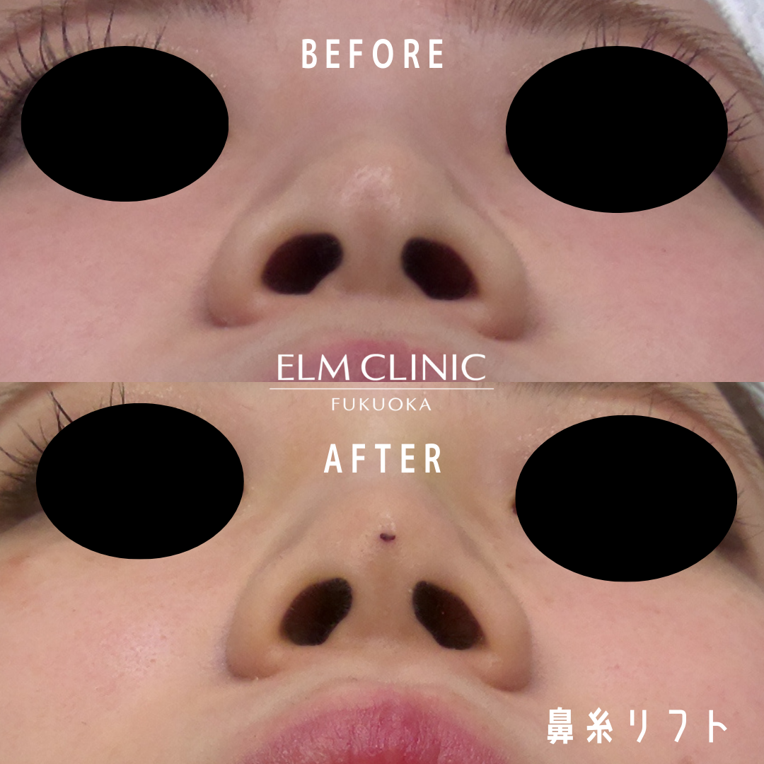 鼻先|エルムリフトの症例写真