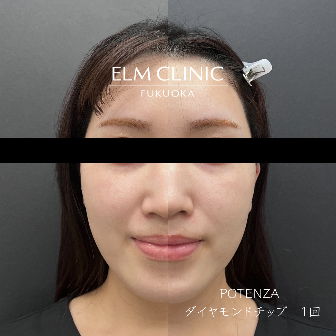 たるみポテンツァ(ダイヤモンドチップ)1回の症例写真